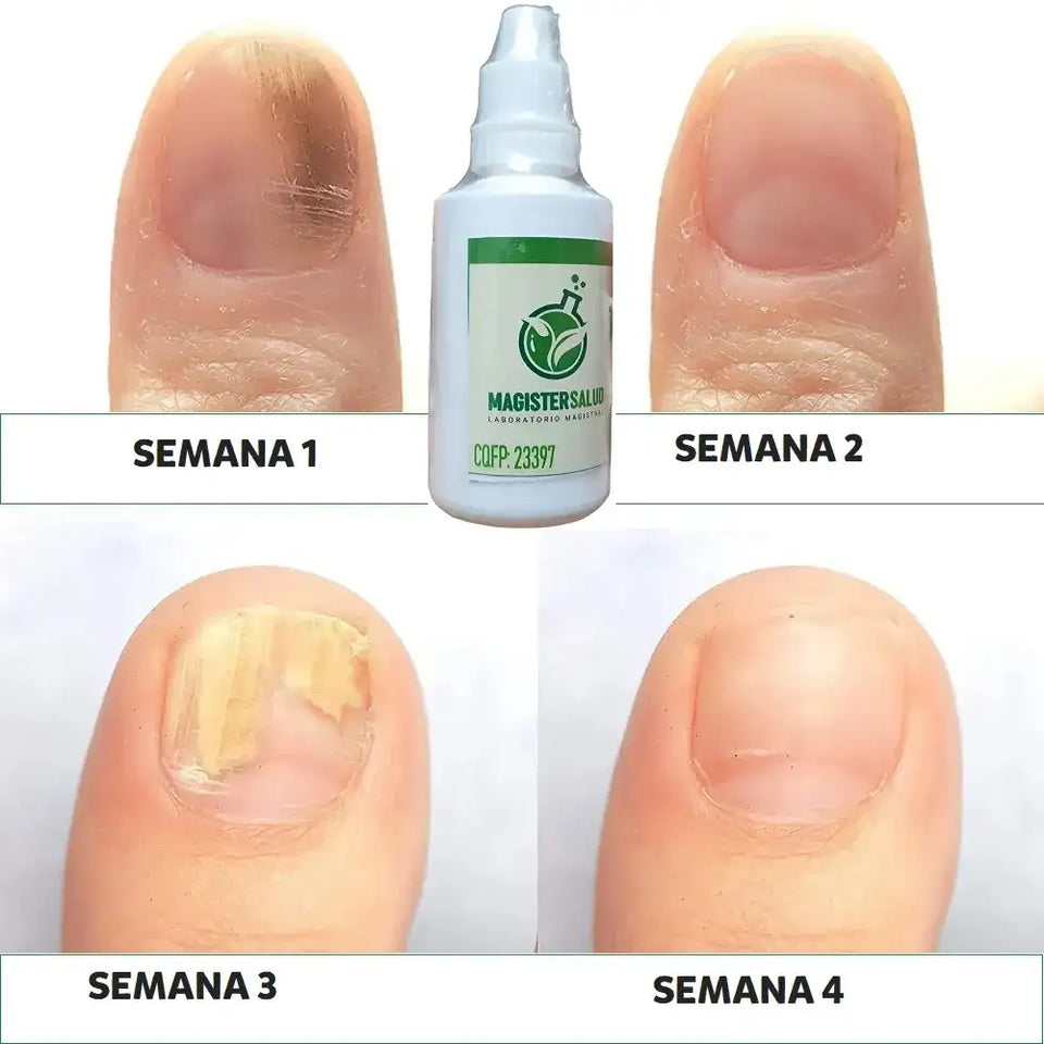TERBINAFINA GOTAS PARA HONGOS EN LAS UÑAS y PIES